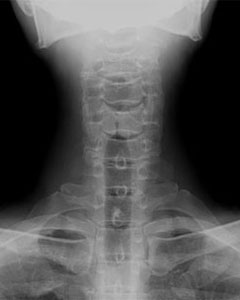 頚椎レントゲン写真1